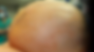 Doctors Remove 132-Pound Nightmare Tumor From Connecticut Woman's Abdomen<em></em>